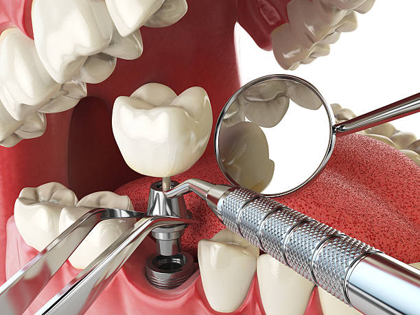 Best Knocked-Out Tooth (Avulsed Tooth) Treatment in French Island, WI