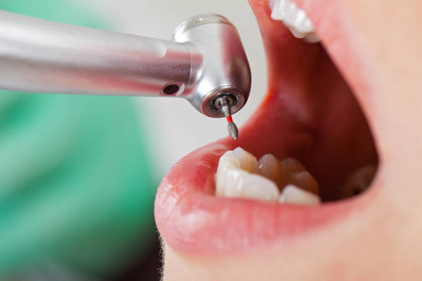 Best Emergency Root Canal Therapy in French Island, WI
